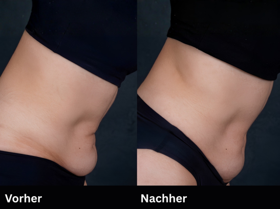 Was ist moderne Körperstraffung?